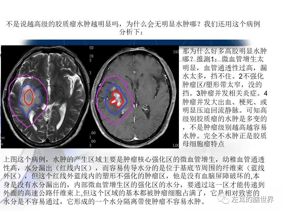 影像PPT - 【PPT】脑肿瘤基础：血脑屏障、强化、水肿-12
