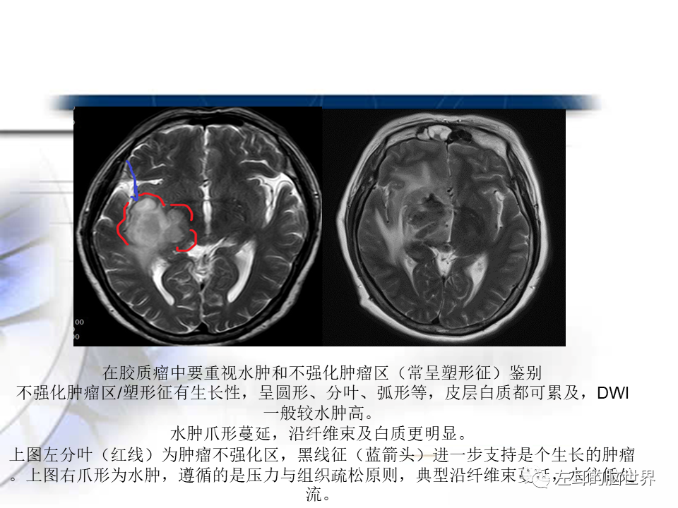 影像PPT - 【PPT】脑肿瘤基础：血脑屏障、强化、水肿-11