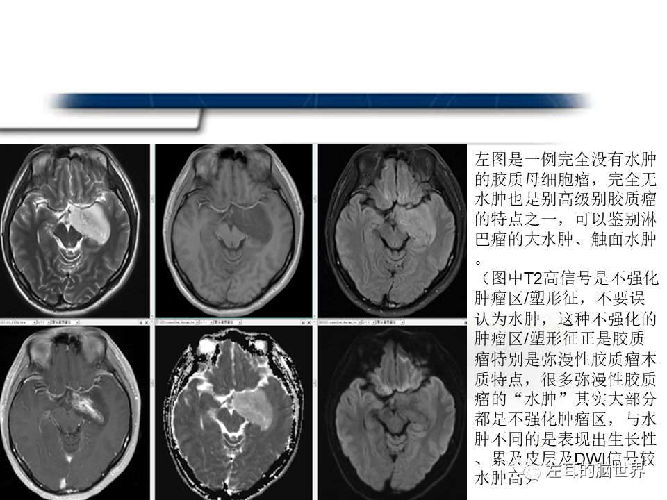 影像PPT - 【PPT】脑肿瘤基础：血脑屏障、强化、水肿-10