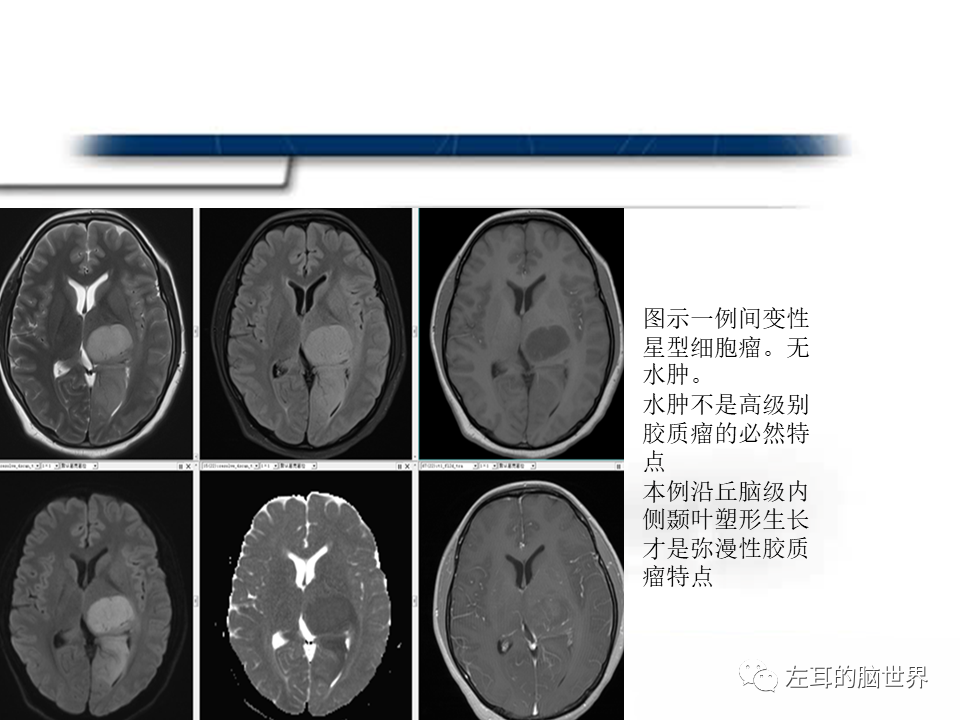 影像PPT - 【PPT】脑肿瘤基础：血脑屏障、强化、水肿-9