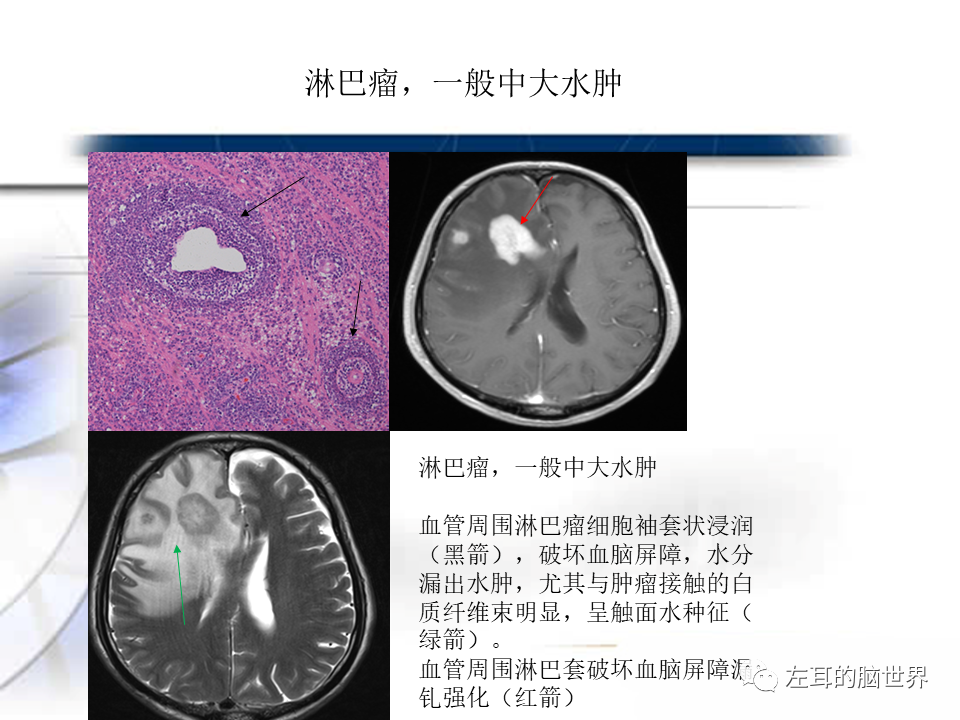 影像PPT - 【PPT】脑肿瘤基础：血脑屏障、强化、水肿-13
