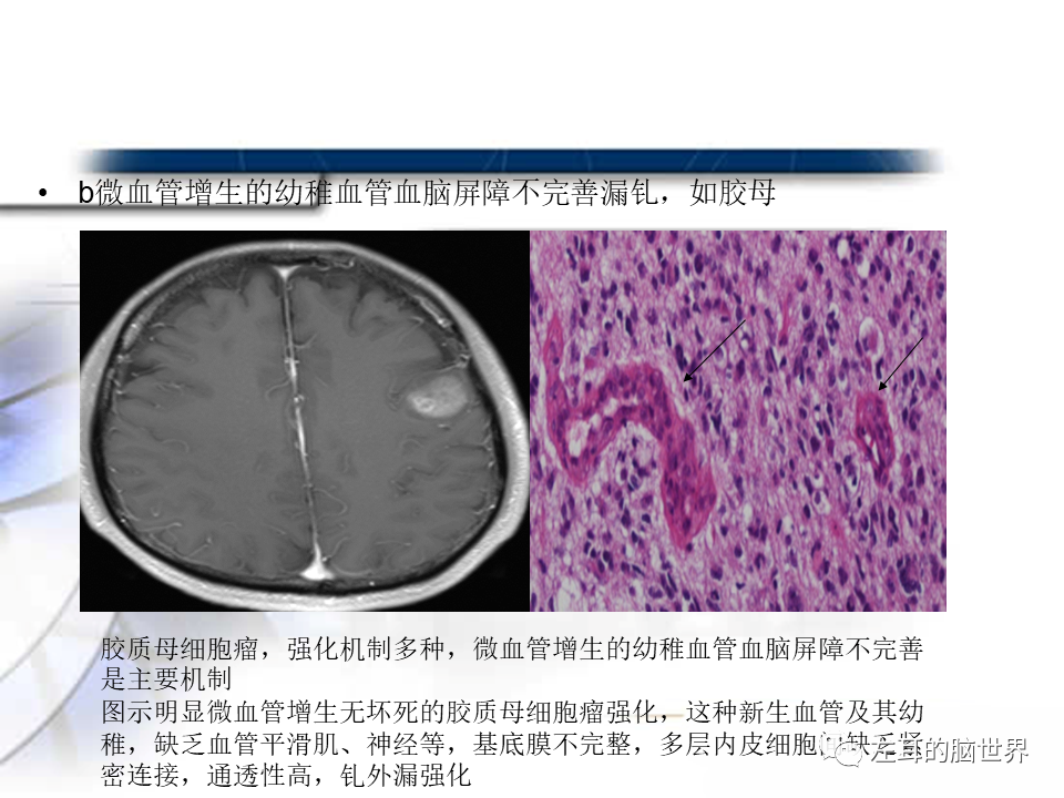 影像PPT - 【PPT】脑肿瘤基础：血脑屏障、强化、水肿-18