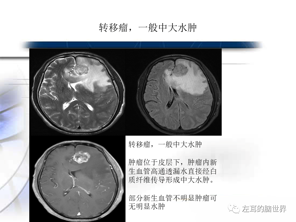 影像PPT - 【PPT】脑肿瘤基础：血脑屏障、强化、水肿-14