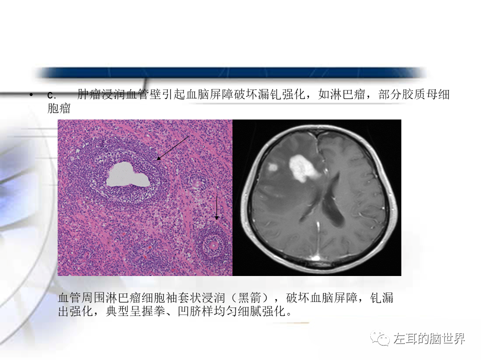 影像PPT - 【PPT】脑肿瘤基础：血脑屏障、强化、水肿-19