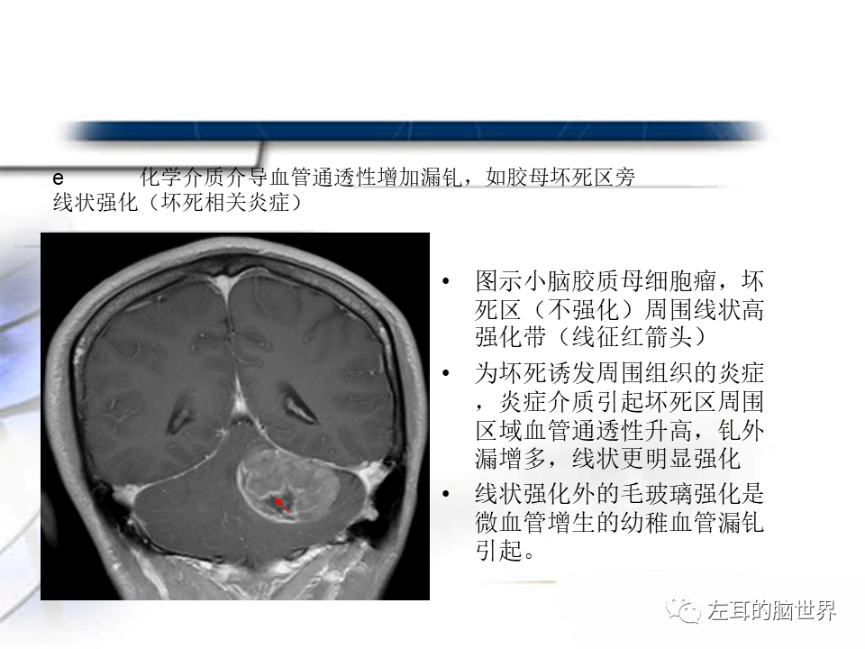 影像PPT - 【PPT】脑肿瘤基础：血脑屏障、强化、水肿-21