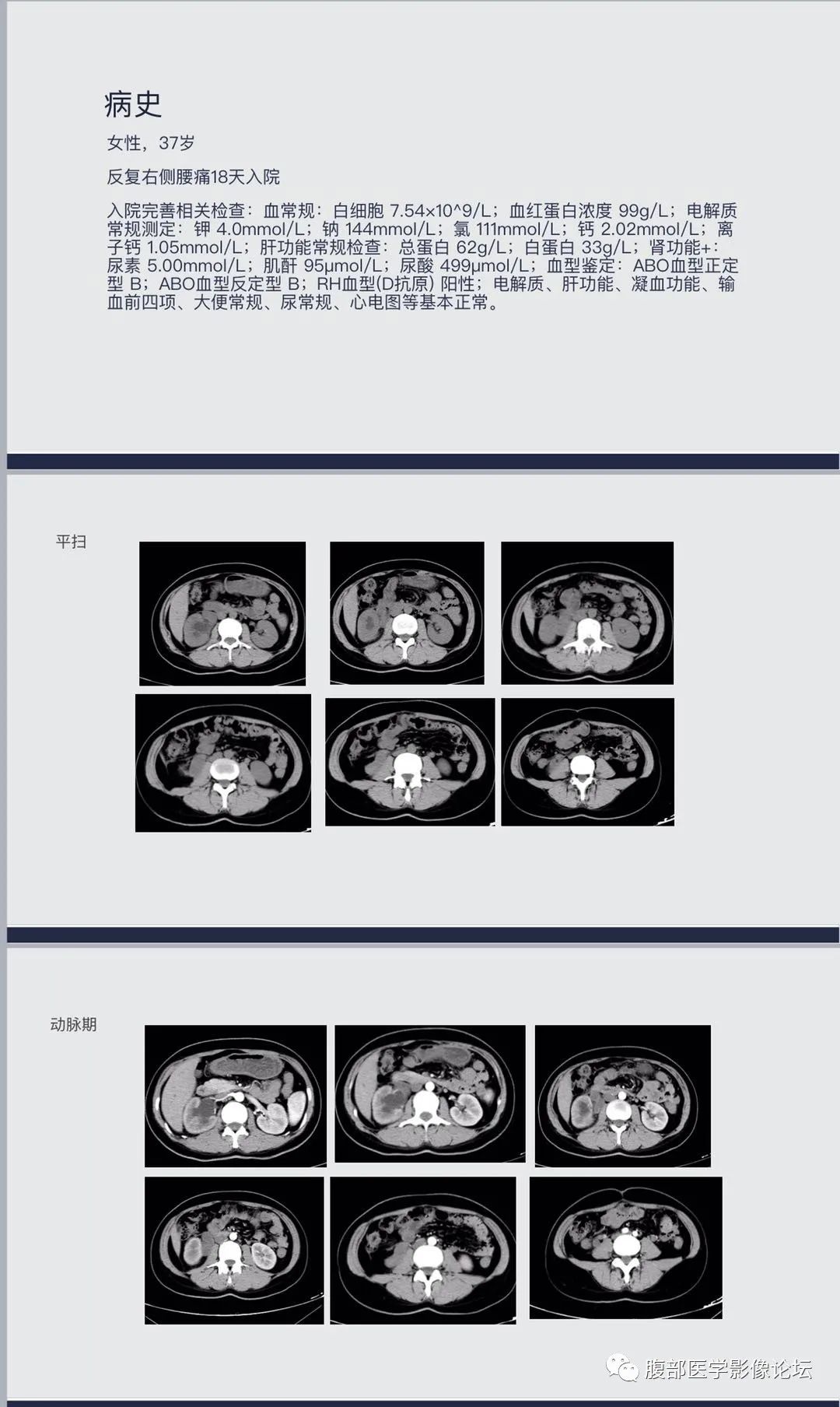 影像PPT - 【病例】腹膜后假性囊肿1例CT影像-2