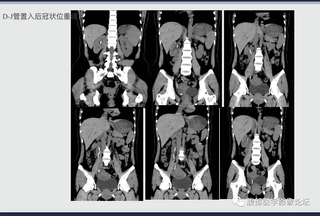 影像PPT - 【病例】腹膜后假性囊肿1例CT影像-4