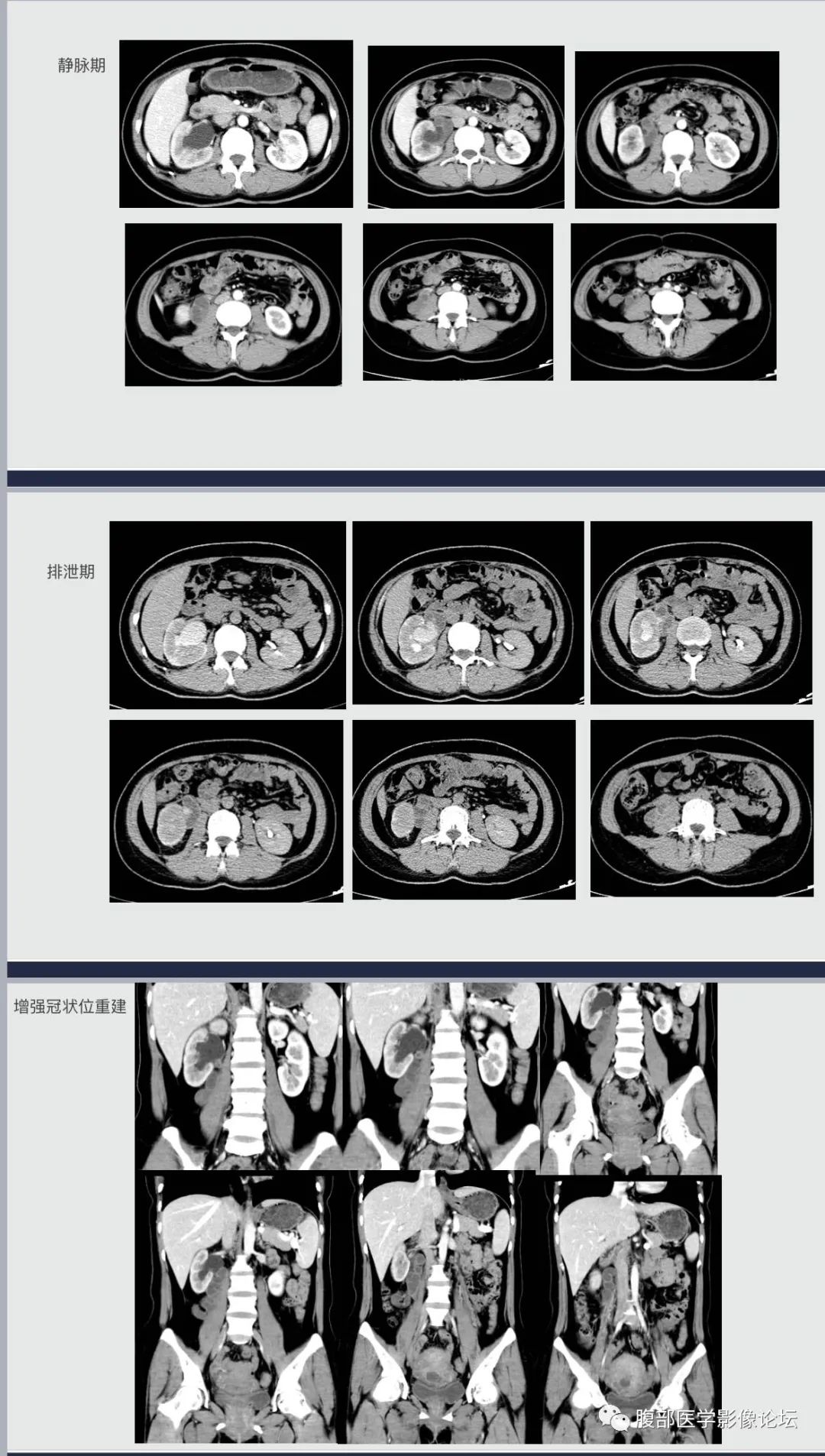 影像PPT - 【病例】腹膜后假性囊肿1例CT影像-3