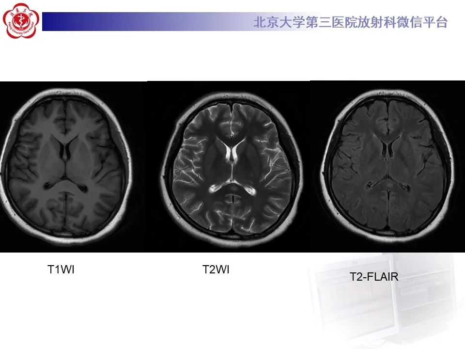 影像PPT - 【PPT】可逆性胼胝体压部病变综合征 RESLES-3