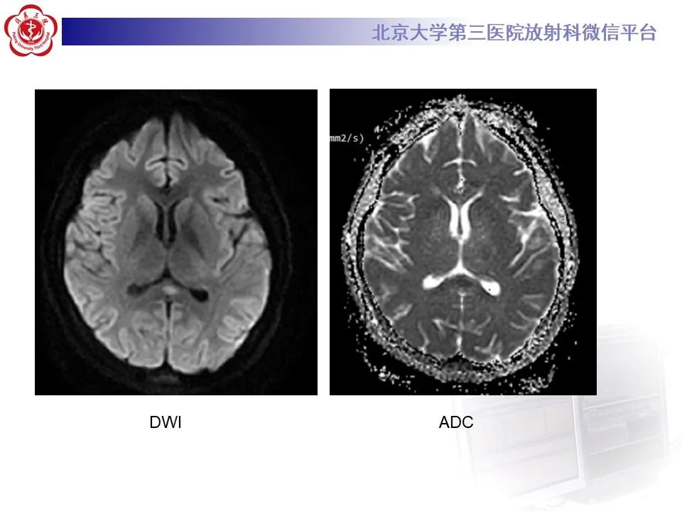 影像PPT - 【PPT】可逆性胼胝体压部病变综合征 RESLES-4