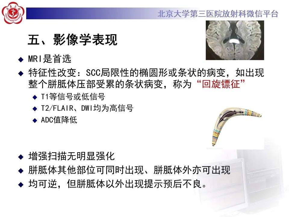 影像PPT - 【PPT】可逆性胼胝体压部病变综合征 RESLES-14