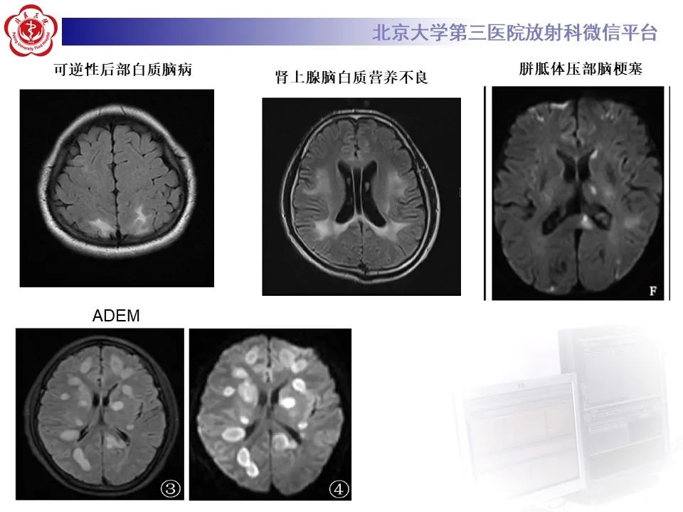 影像PPT - 【PPT】可逆性胼胝体压部病变综合征 RESLES-17