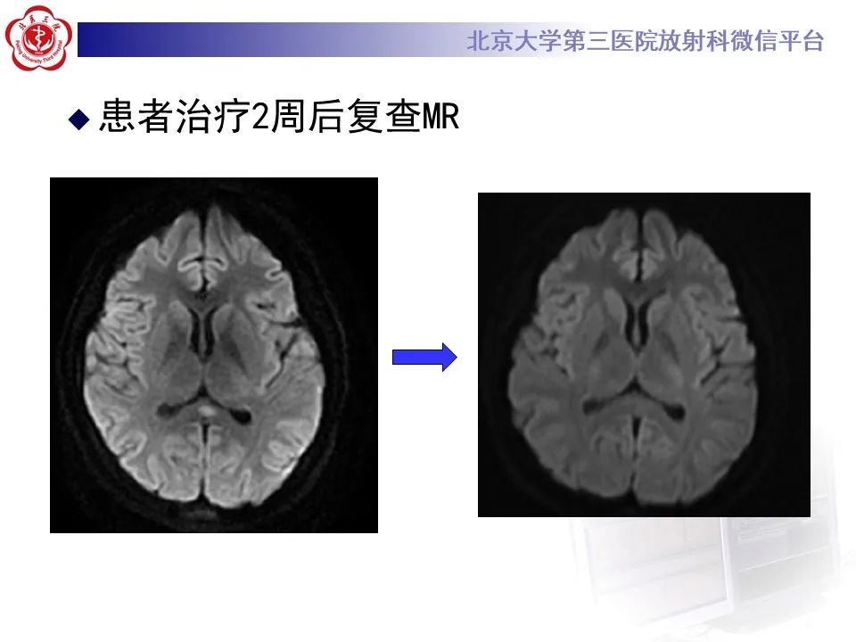 影像PPT - 【PPT】可逆性胼胝体压部病变综合征 RESLES-19