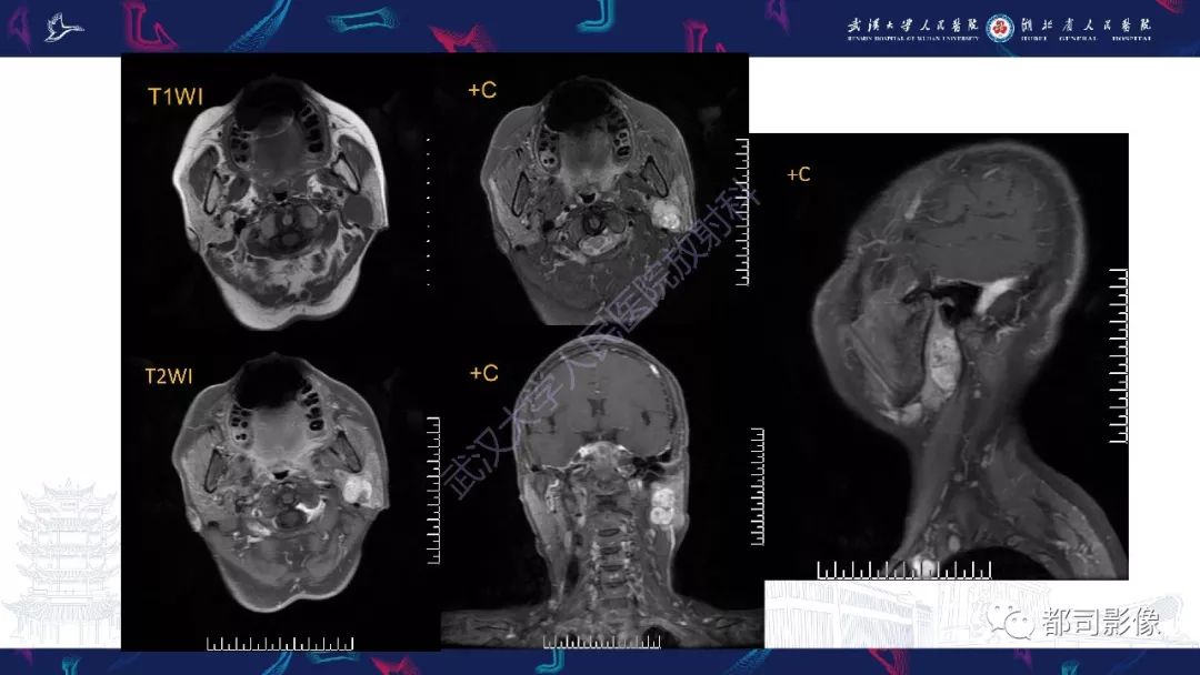 影像PPT - 【PPT】腮腺基底细胞腺瘤影像诊断-3
