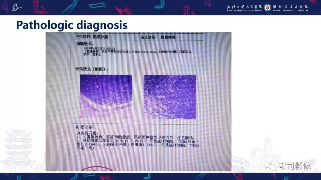 影像PPT - 【PPT】腮腺基底细胞腺瘤影像诊断-5