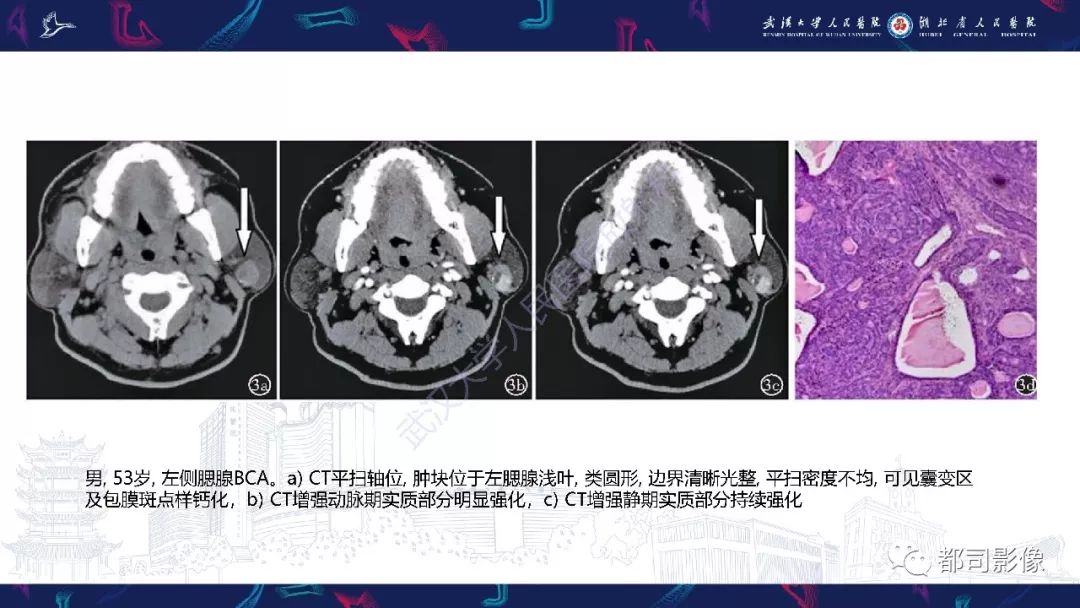 影像PPT - 【PPT】腮腺基底细胞腺瘤影像诊断-14