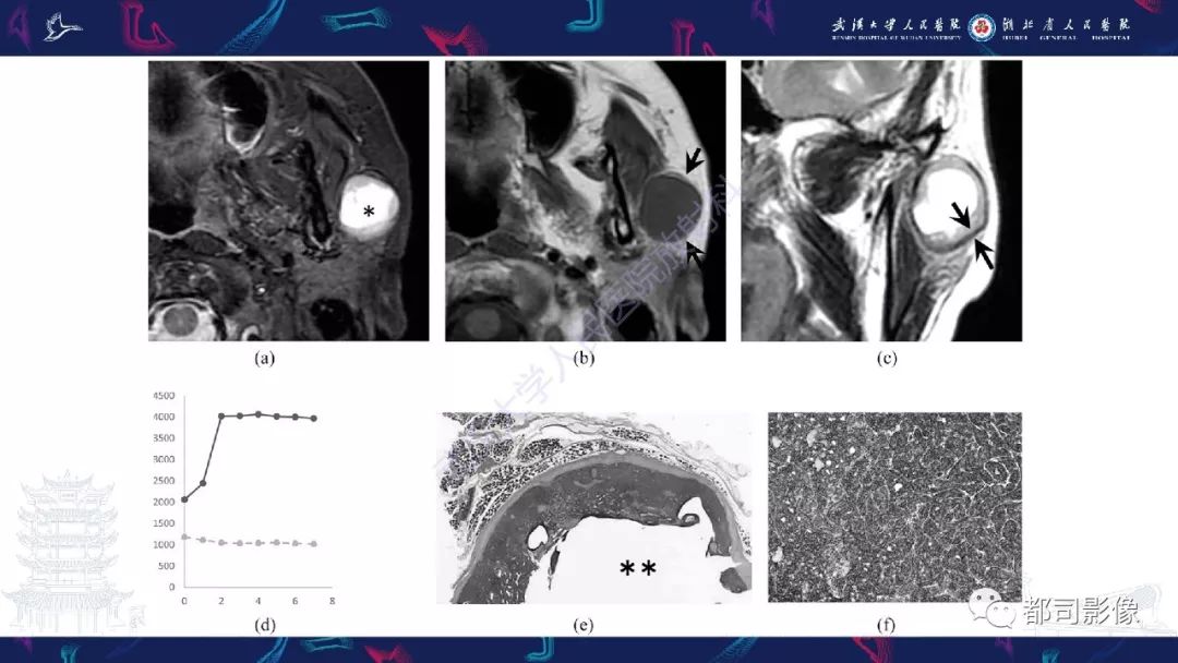 影像PPT - 【PPT】腮腺基底细胞腺瘤影像诊断-17