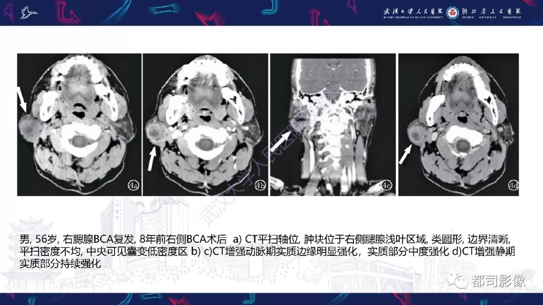 影像PPT - 【PPT】腮腺基底细胞腺瘤影像诊断-15