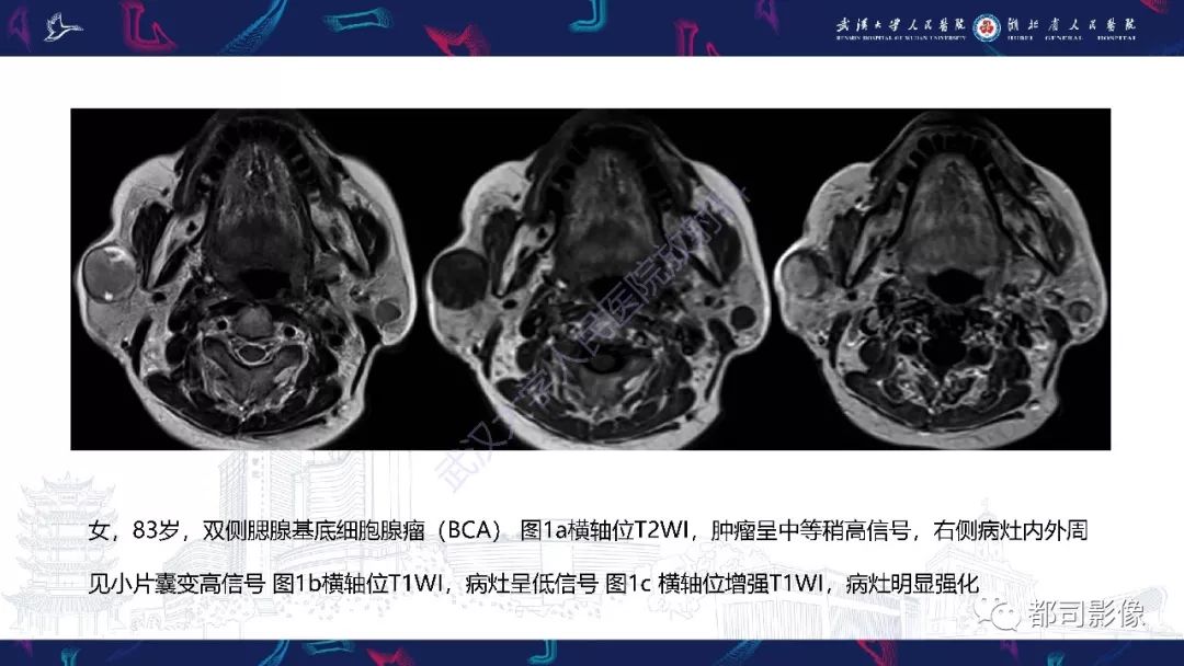 影像PPT - 【PPT】腮腺基底细胞腺瘤影像诊断-18