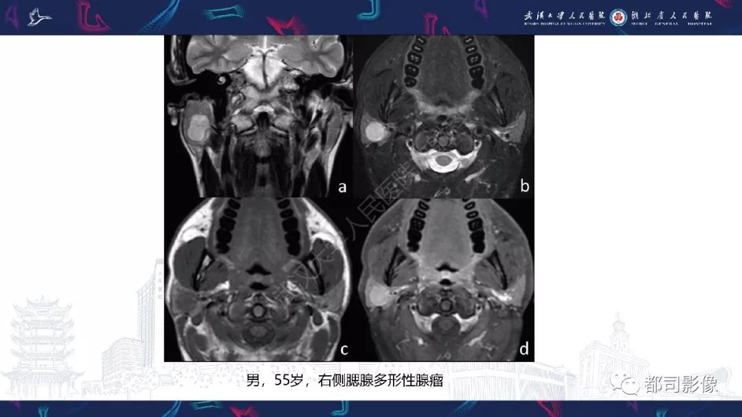 影像PPT - 【PPT】腮腺基底细胞腺瘤影像诊断-22