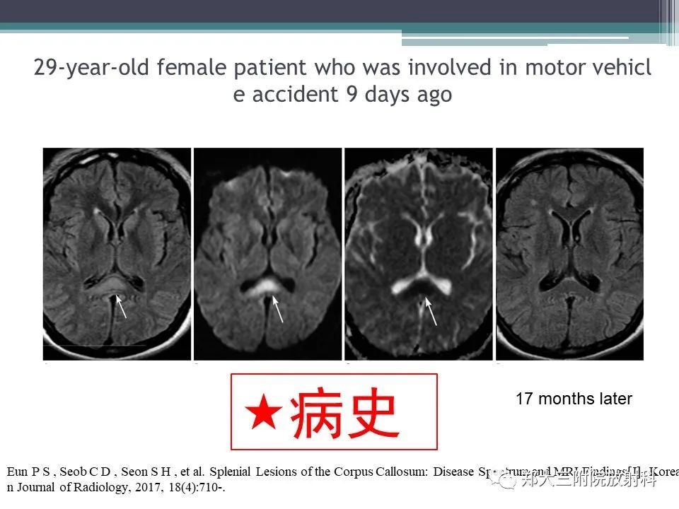 影像PPT - 【PPT】胼胝体病变的诊断思路-17