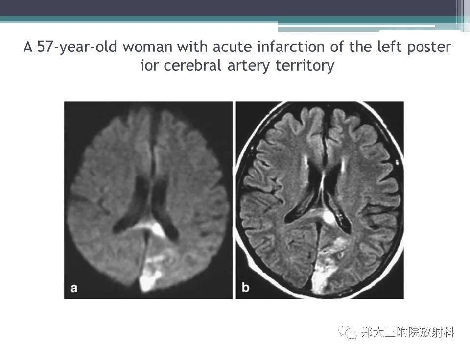 影像PPT - 【PPT】胼胝体病变的诊断思路-21