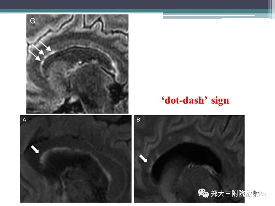 影像PPT - 【PPT】胼胝体病变的诊断思路-24