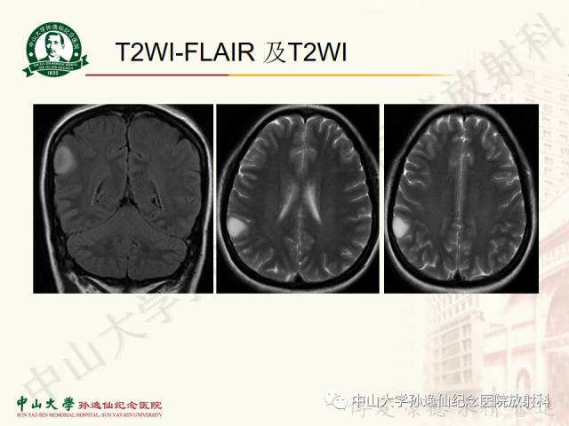 影像PPT - 【病例】囊性胶质瘤1例MR影像-3