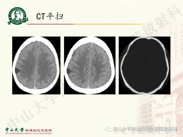 影像PPT - 【病例】囊性胶质瘤1例MR影像-2