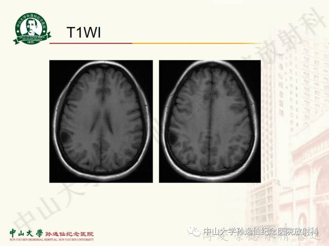 影像PPT - 【病例】囊性胶质瘤1例MR影像-4