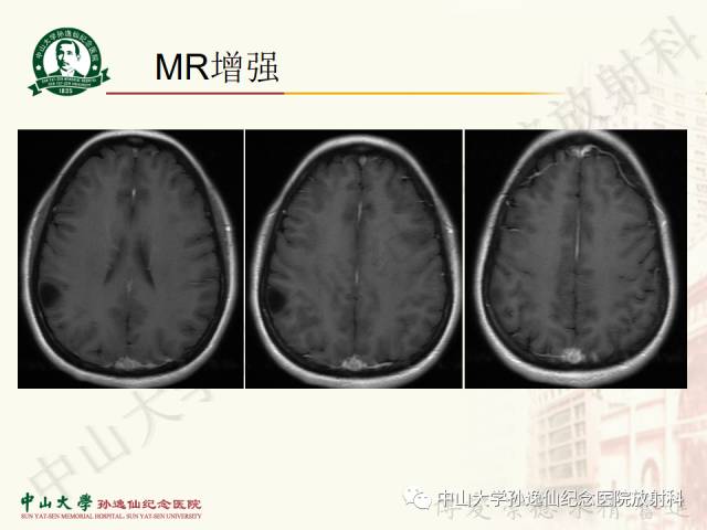 影像PPT - 【病例】囊性胶质瘤1例MR影像-5