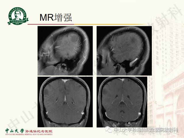 影像PPT - 【病例】囊性胶质瘤1例MR影像-6