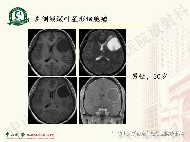 影像PPT - 【病例】囊性胶质瘤1例MR影像-13
