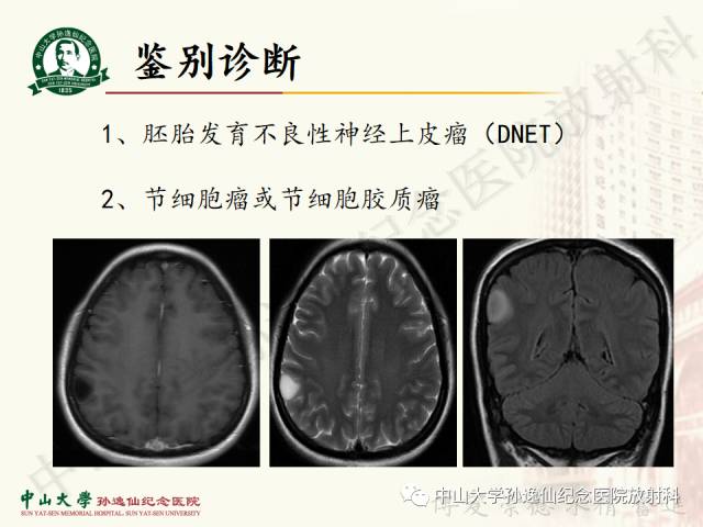 影像PPT - 【病例】囊性胶质瘤1例MR影像-14