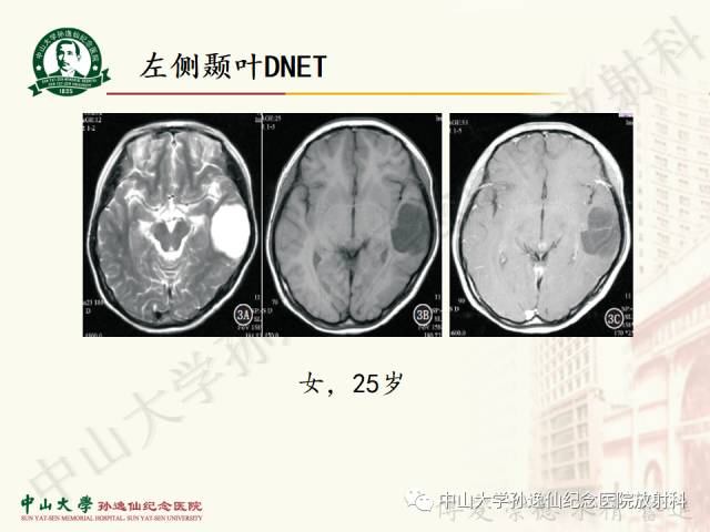 影像PPT - 【病例】囊性胶质瘤1例MR影像-18