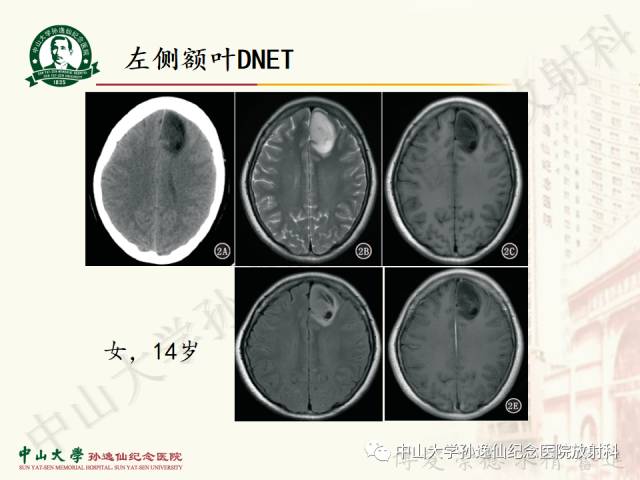 影像PPT - 【病例】囊性胶质瘤1例MR影像-17