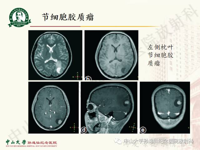 影像PPT - 【病例】囊性胶质瘤1例MR影像-21