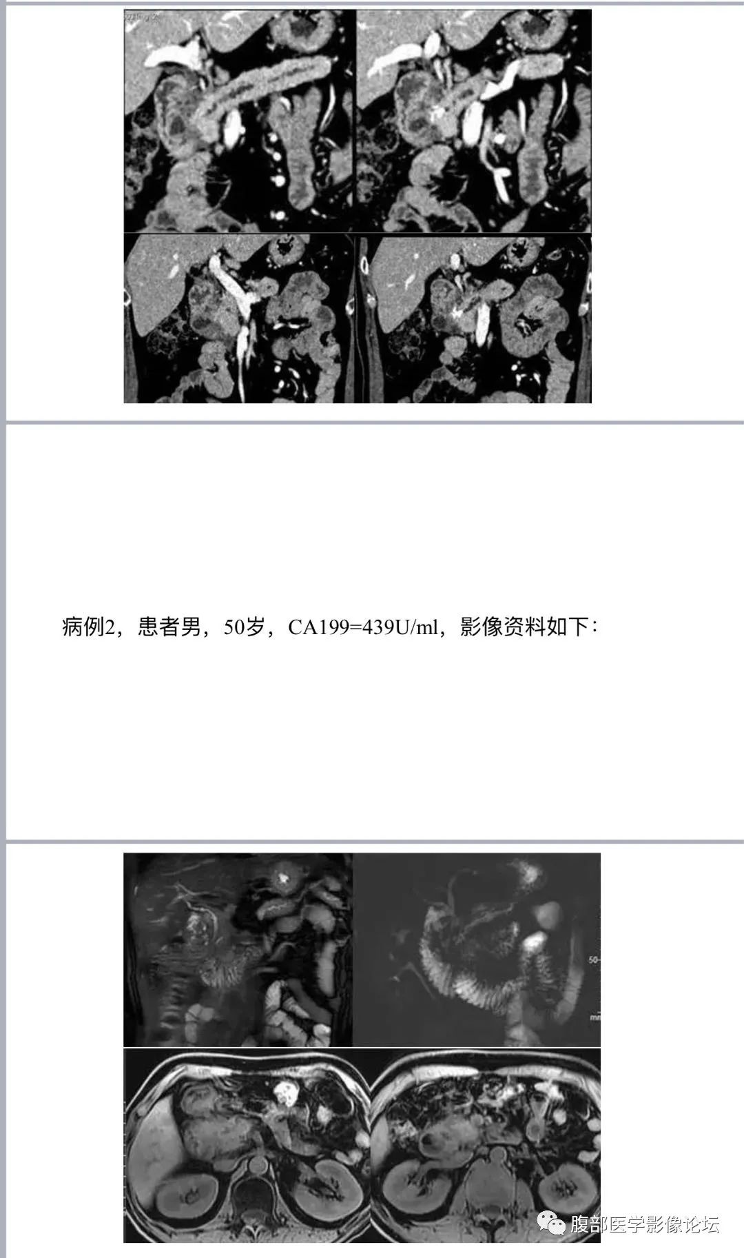 影像PPT - 【病例】胰腺炎三例CT及MR-2