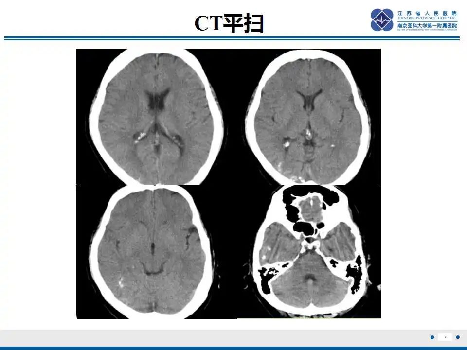 影像PPT - 【PPT】Sturge-Weber综合症-4