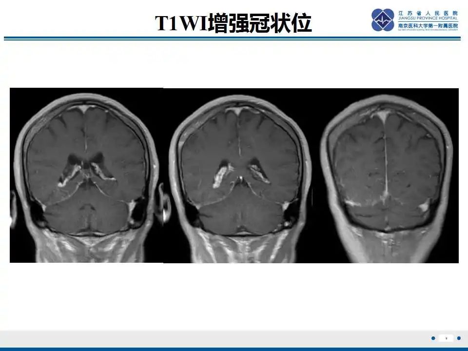 影像PPT - 【PPT】Sturge-Weber综合症-11