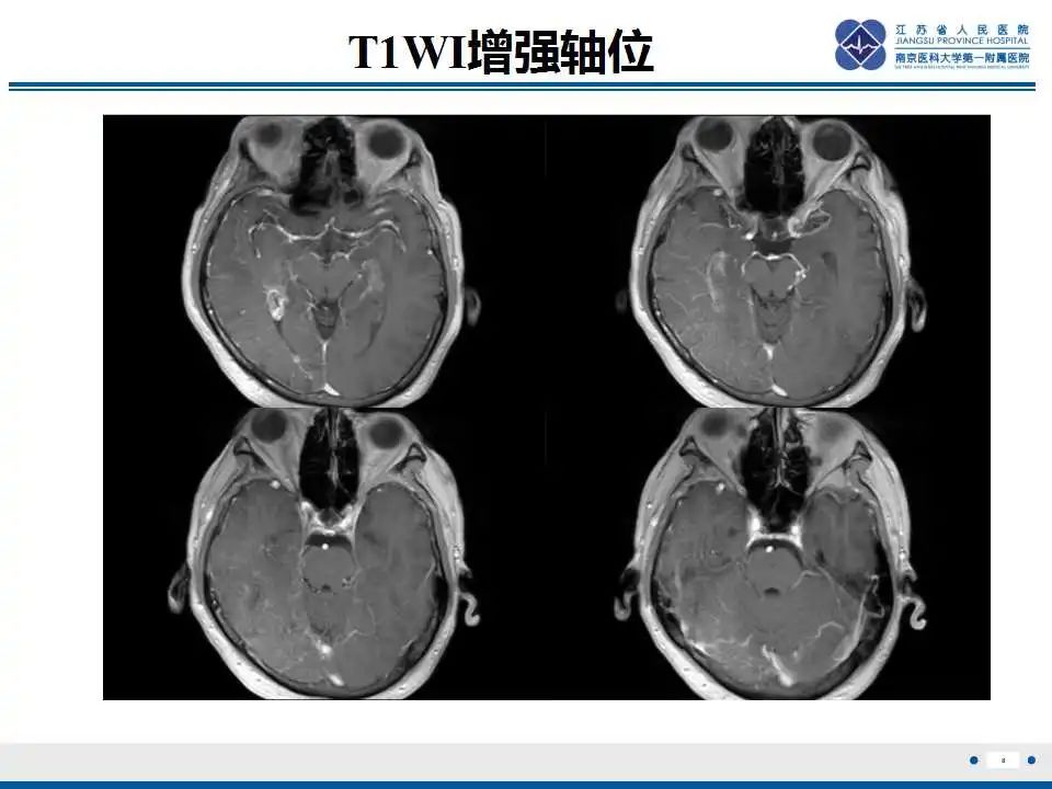 影像PPT - 【PPT】Sturge-Weber综合症-10