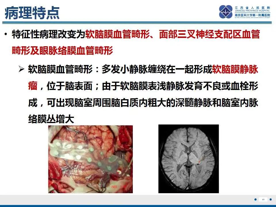 影像PPT - 【PPT】Sturge-Weber综合症-25