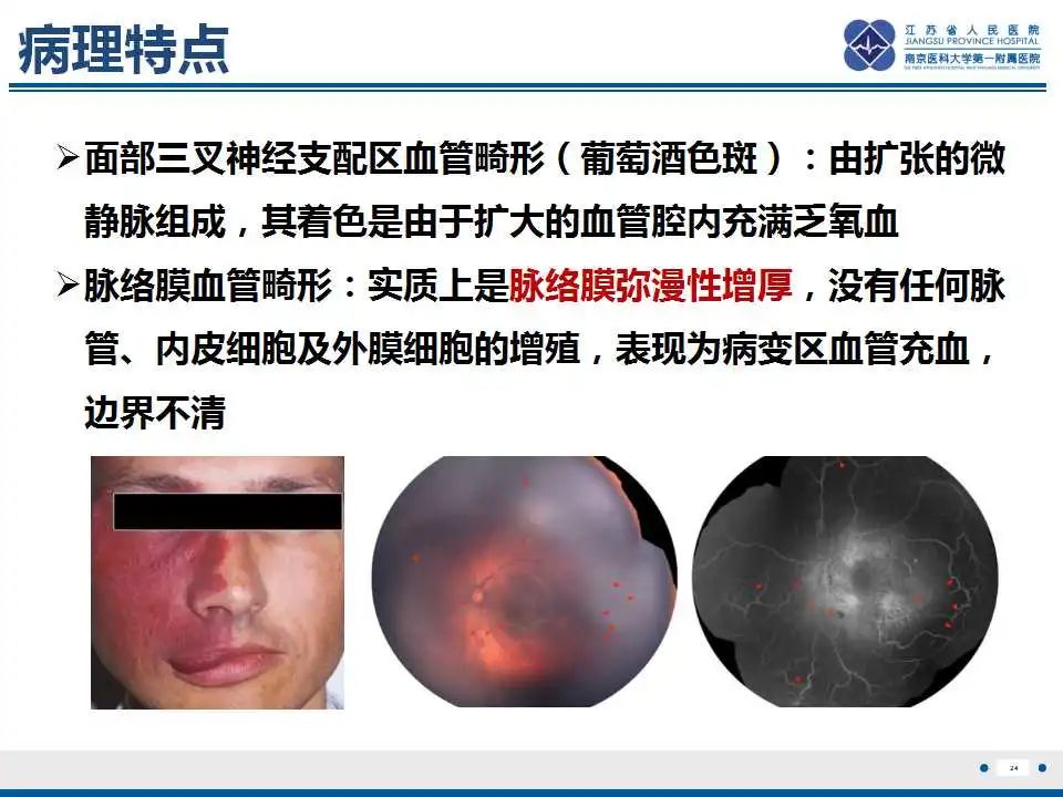 影像PPT - 【PPT】Sturge-Weber综合症-26