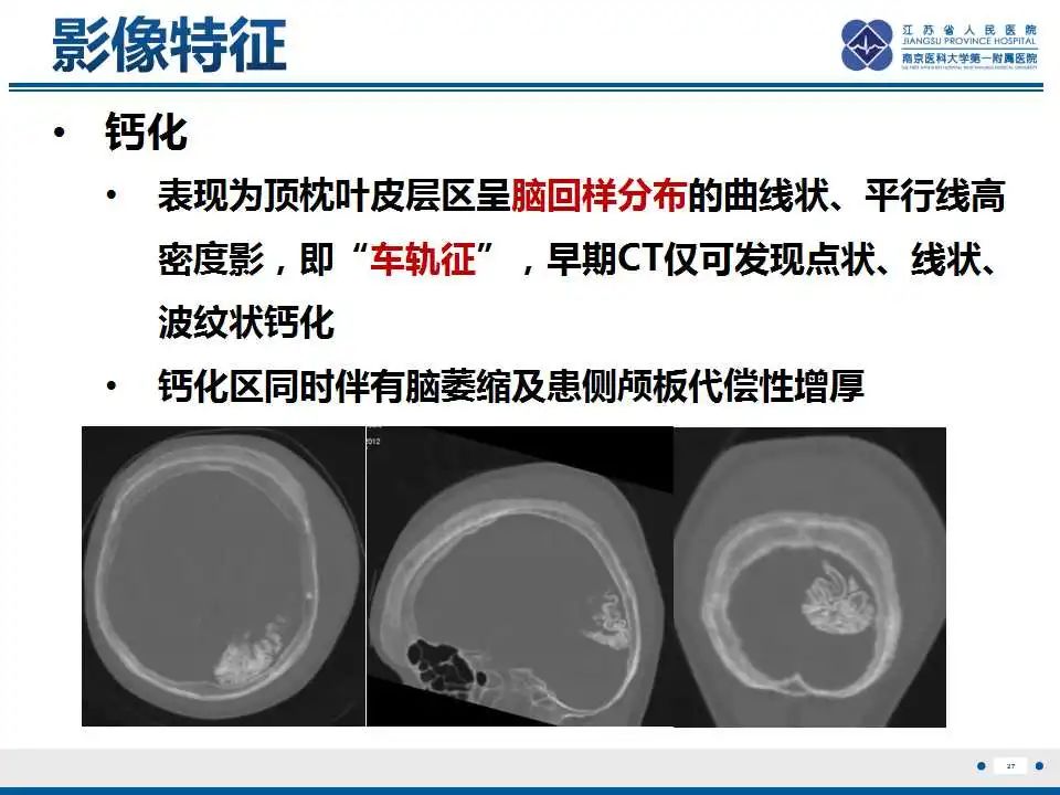 影像PPT - 【PPT】Sturge-Weber综合症-29