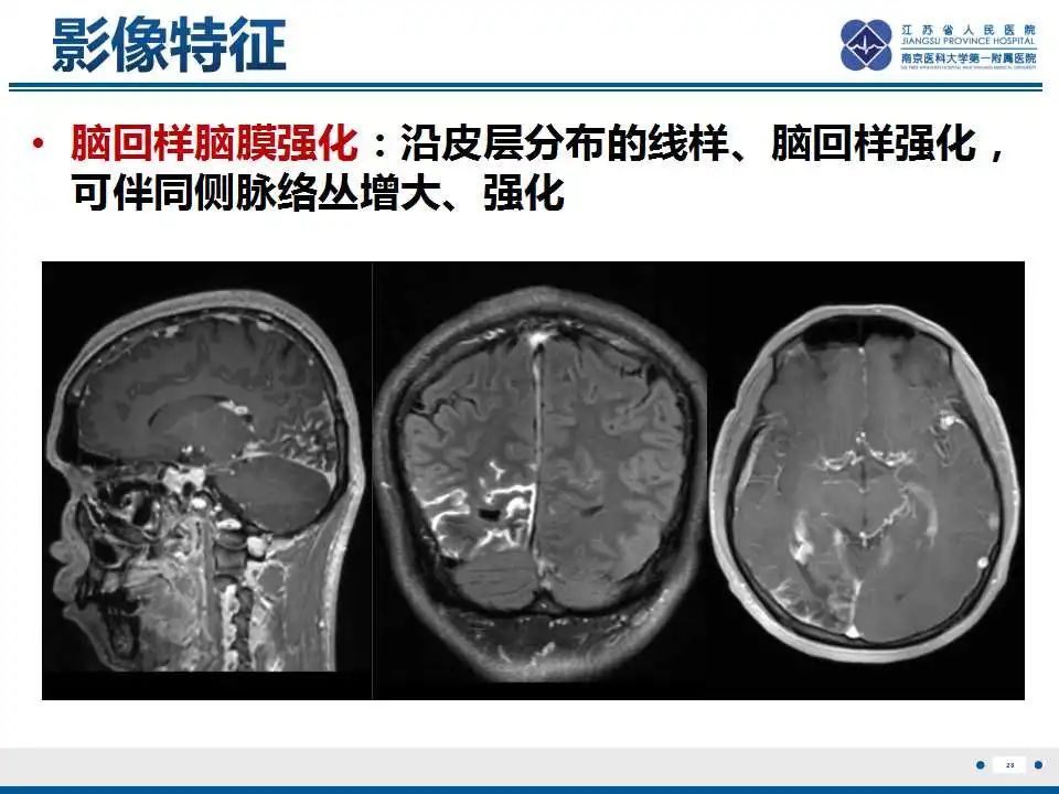 影像PPT - 【PPT】Sturge-Weber综合症-30