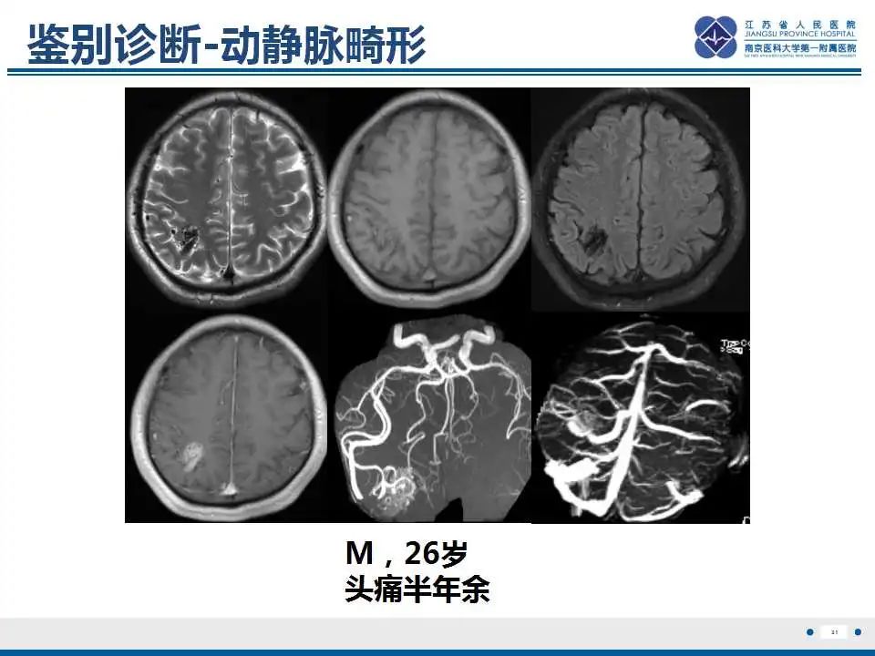 影像PPT - 【PPT】Sturge-Weber综合症-33