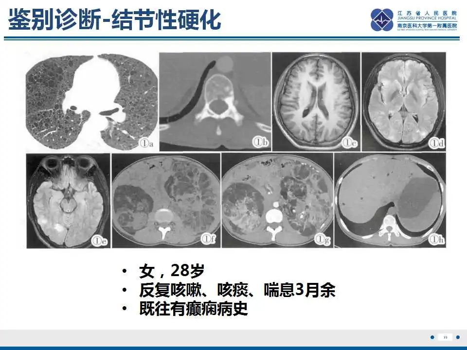 影像PPT - 【PPT】Sturge-Weber综合症-35