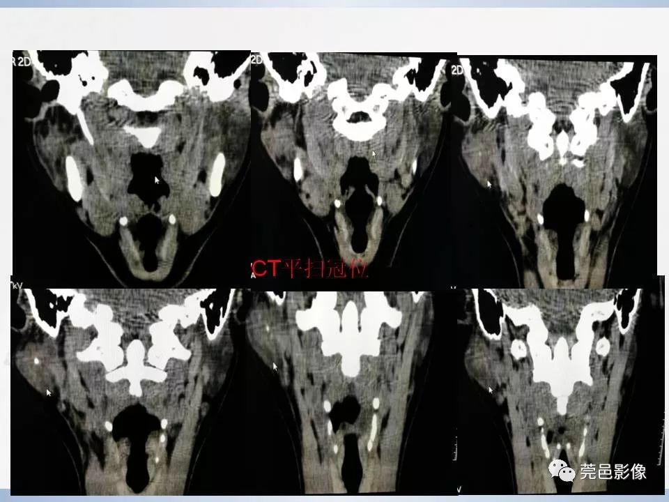 影像PPT - 【PPT】腮腺黏液表皮样癌的CT诊断与鉴别诊断-6