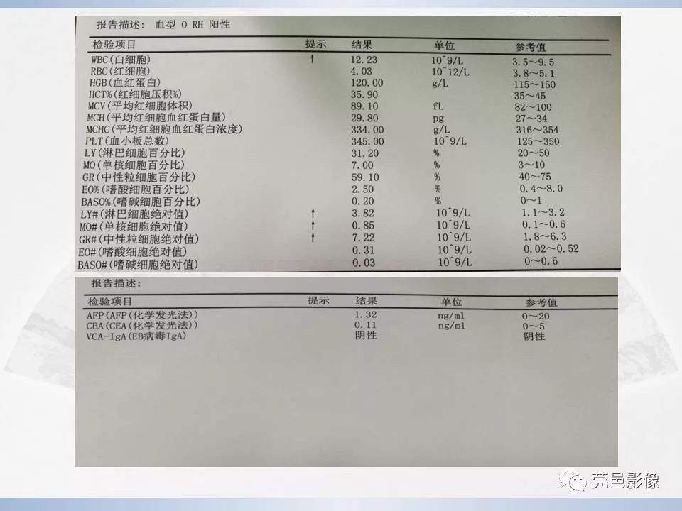 影像PPT - 【PPT】腮腺黏液表皮样癌的CT诊断与鉴别诊断-3