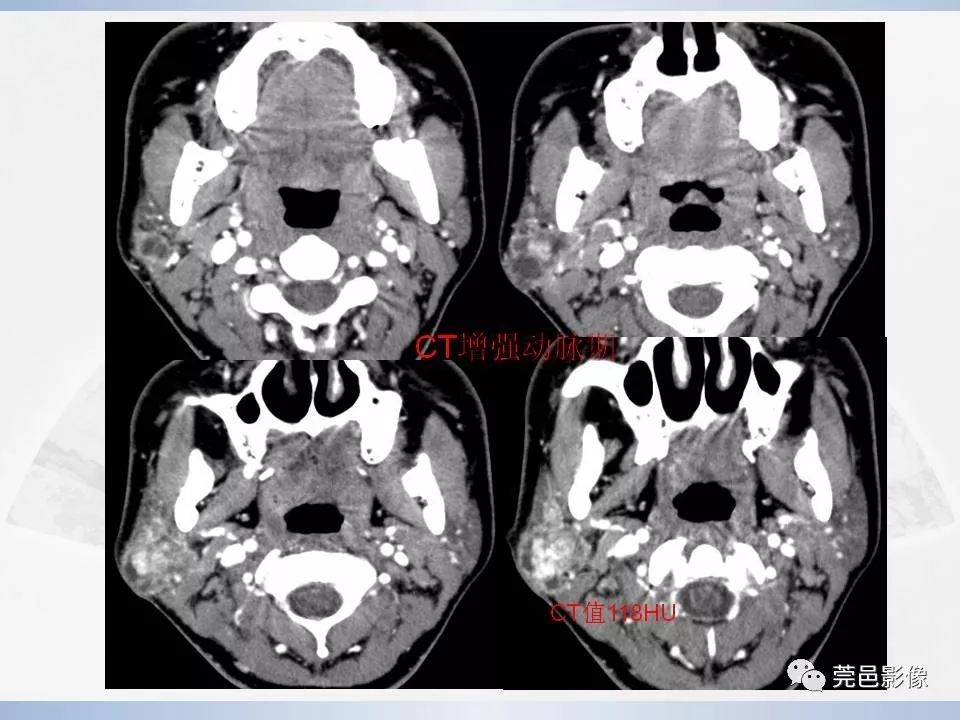 影像PPT - 【PPT】腮腺黏液表皮样癌的CT诊断与鉴别诊断-7
